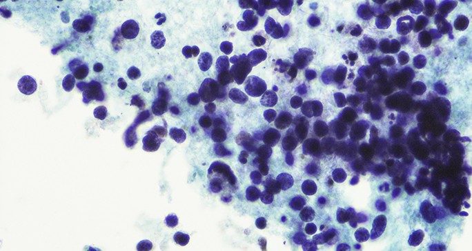 小细胞肺癌分类的新进展:更精准的治疗新希望