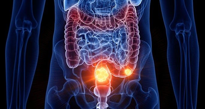 直肠乙状结肠癌:了解左侧结肠癌的特征与治疗要点