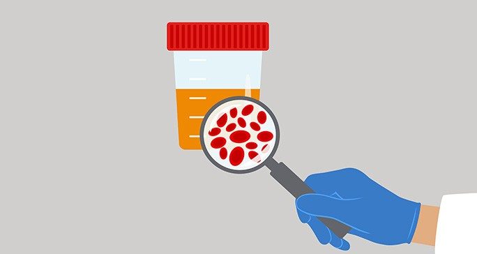 尿液带血(血尿):常见原因及应对措施