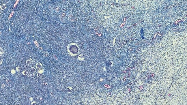 什么是“肿瘤”?一次读懂肿瘤的种类、症状与治疗方式