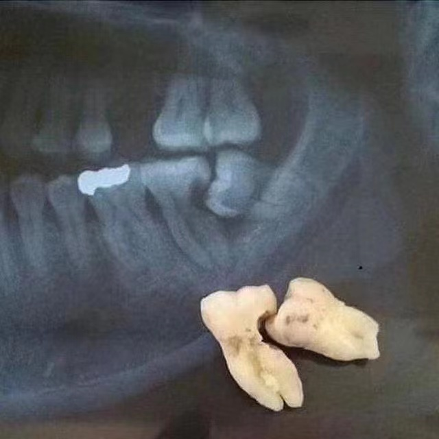 拔牙流程一次性告诉你！详细！！！