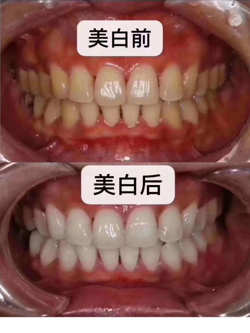 冷光美白