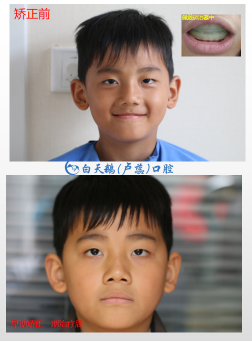 儿童矫正