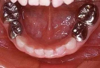 儿牙预成冠
