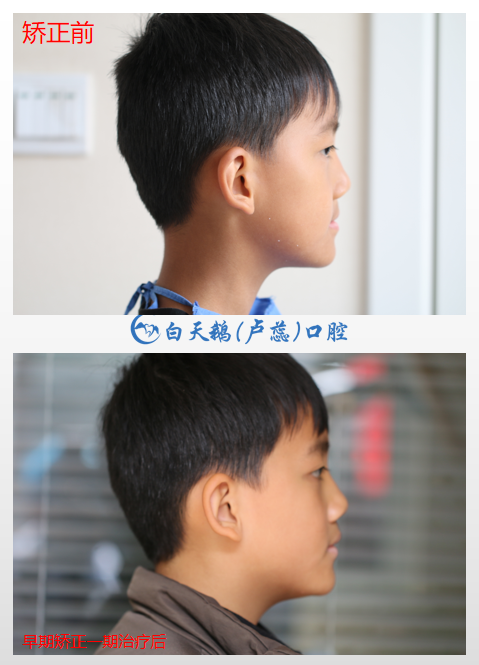 儿童矫正