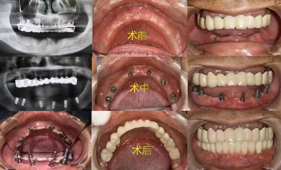 下半口缺失后种植