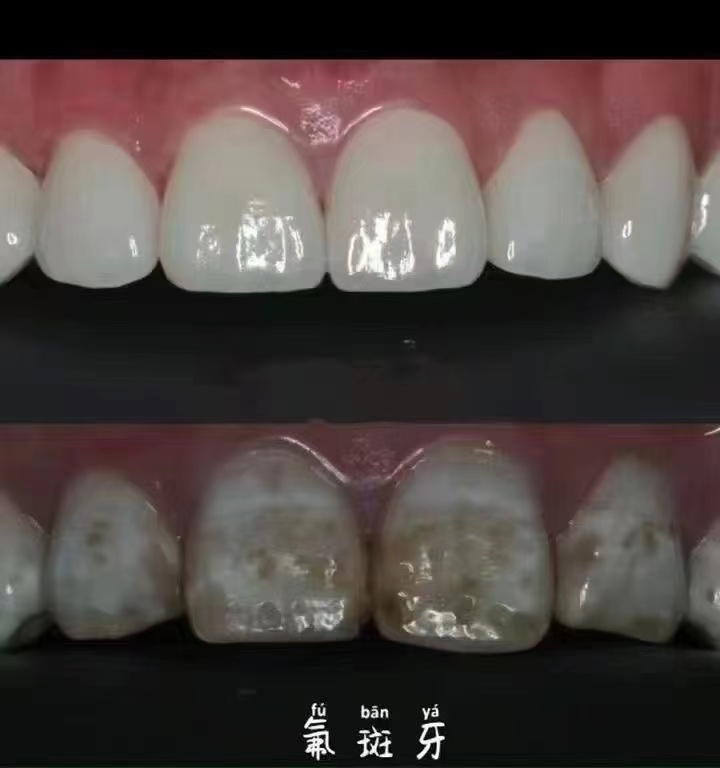 氟斑牙