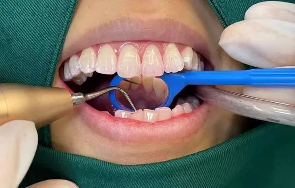 采用更细微颗粒的甘氨酸砂粉为洁牙者进行浅龈下喷砂,精细去******斑