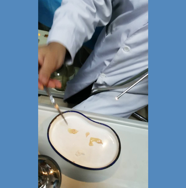 上药后脱落的息肉