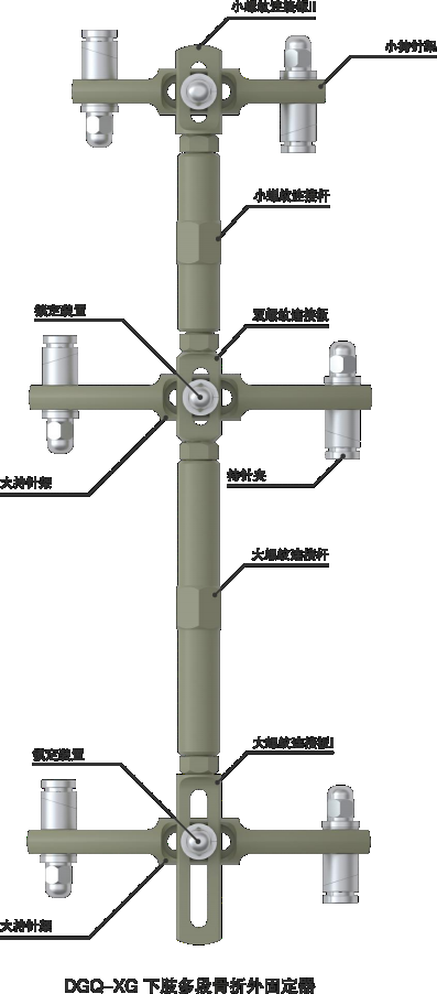 下肢多段骨折外固定器